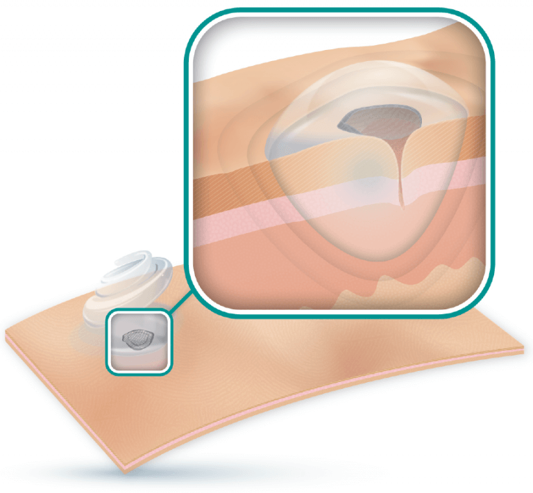 Hydrogel Dressing Wound Care Range ActivHeal Hydrogel